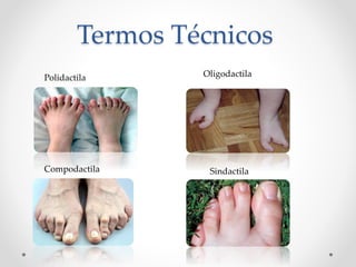 Termos Técnicos
Polidactila Oligodactila
Compodactila Sindactila
 