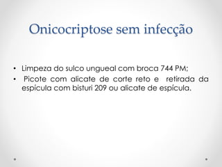 Onicocriptose sem infecção
• Limpeza do sulco ungueal com broca 744 PM;
• Picote com alicate de corte reto e retirada da
espícula com bisturi 209 ou alicate de espícula.
 