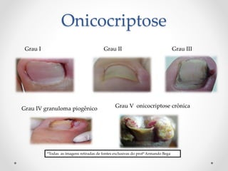 Onicocriptose
Grau I Grau II Grau III
Grau IV granuloma piogênico Grau V onicocriptose crônica
*Todas as imagens retiradas de fontes exclusivas do profº Armando Bega
 