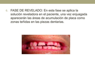 6. FASE DE REVELADO: En esta fase se aplica la

solución reveladora en el paciente, una vez enjuagada
aparecerán las áreas de acumulación de placa como
zonas teñidas en las piezas dentarias.

 