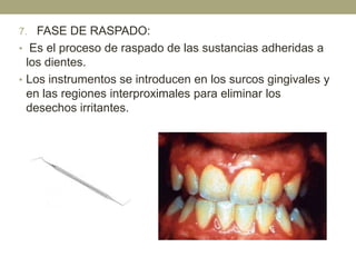 7. FASE DE RASPADO:
• Es el proceso de raspado de las sustancias adheridas a

los dientes.
• Los instrumentos se introducen en los surcos gingivales y
en las regiones interproximales para eliminar los
desechos irritantes.

 