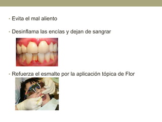 • Evita el mal aliento
• Desinflama las encías y dejan de sangrar

• Refuerza el esmalte por la aplicación tópica de Flor

 
