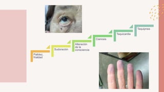 Palidez,
frialdad
Sudoración
Alteración
de la
consciencia
Cianosis
Taquicardia
Taquipnea
 