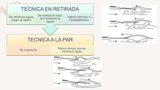 TECNICA A LA PAR
Se inyecta AL
Mismo tiempo que se
introduce aguja
TECNICA EN RETIRADA
Se introduce aguja,
luego se aspira
Se inyecta la soluc
al ir retirando la
aguja
Habóm dérmico o
intraepidérmico
 