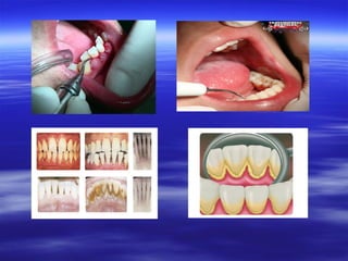 Profilaxis o limpieza dental