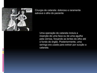 Cirurgia de catarata: doloroso e raramente
salvava o olho do paciente




    Uma operação de catarata incluía a
    inserção de uma faca ou de uma agulha
    pela córnea, forçando as lentes do olho até
    o fundo do órgão. Posteriormente, uma
    seringa era usada para extrair por sucção a
    catarata.
 