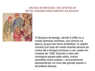 . Bexiga bloqueada: um cateter de
metal inserido diretamente na bexiga




      O bloqueio da bexiga, devido à sífilis ou a
      outras doenças venéreas, era comum na
      época, já que não havia antibiótico. O cateter
      urinário (um tubo de metal inserido através da
      uretra até a bexiga) começou a ser usado em
      meados de 1300. Quando o tubo não
      conseguia passar pela uretra, outros
      aparelhos eram usados – provavelmente
      apresentando um risco tão grande quanto o
      da própria doença.
 