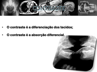 • O contraste é a diferenciação dos tecidos;
• O contraste é a absorção diferencial.
 
