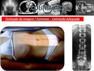 Formação da Imagem / Contraste – Colimação Adequada
 