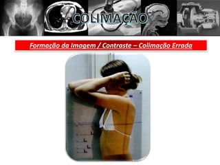 Formação da Imagem / Contraste – Colimação Errada
 
