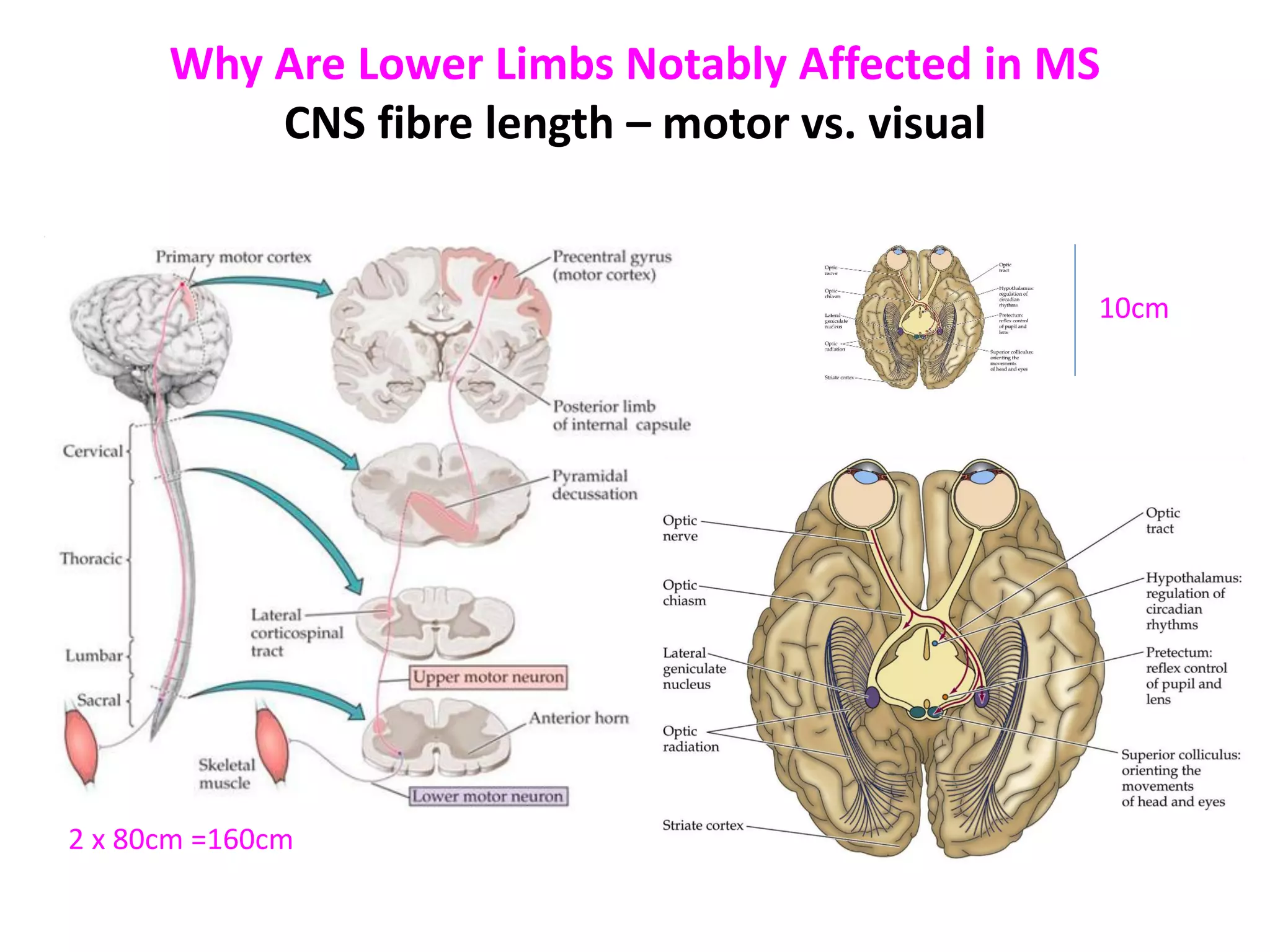 Why Are Lower Limbs Notably Affected in MS
CNS fibre length – motor vs. visual
10cm
2 x 80cm =160cm
 
