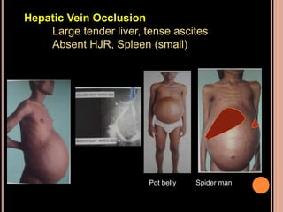 Pot belly Spider man
Hepatic Vein Occlusion
Large tender liver, tense ascites
Absent HJR, Spleen (small)
 