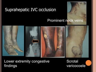 Scrotal
varicocoele
Lower extremity congestive
findings
Prominent neck veins
Suprahepatic IVC occlusion
 