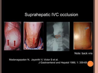 Suprahepatic IVC occlusion
Note: back vns
Madanagopalan N, Jayanthi V, Victor S et al.
J Gastroenterol and Hepatol 1986; 1: 359-69
 
