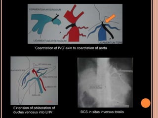 Extension of obliteration of
ductus venosus into LHV BCS in situs inversus totalis
‘Coarctation of IVC’ akin to coarctation of aorta
 
