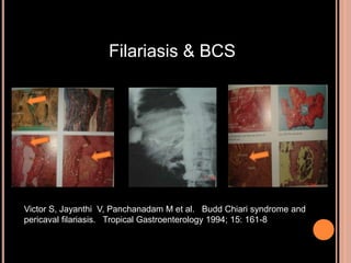 Filariasis & BCS
Victor S, Jayanthi V, Panchanadam M et al. Budd Chiari syndrome and
pericaval filariasis. Tropical Gastroenterology 1994; 15: 161-8
 