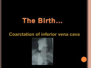 Coarctation of inferior vena cava
 