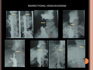 BIDIRECTIONAL VENACAVOGRAM
 