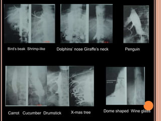 Bird’s beak Shrimp-like Dolphins’ nose Giraffe’s neck
X-mas treeCarrot Cucumber Drumstick
Dome shaped Wine glass
Penguin
 