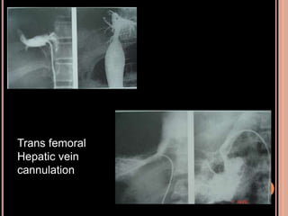 Trans femoral
Hepatic vein
cannulation
 