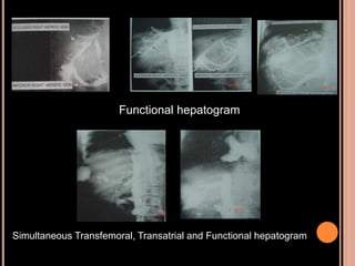 Simultaneous Transfemoral, Transatrial and Functional hepatogram
Functional hepatogram
 