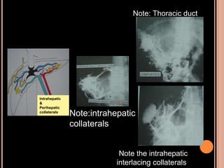 Intrahepatic
&
Perihepatic
collaterals
Note the intrahepatic
interlacing collaterals
Note: Thoracic duct
Note:intrahepatic
collaterals
 