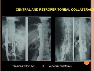 Thrombus within IVC & Vertebral collaterals
CENTRAL AND RETROPERITONEAL COLLATERALS
 