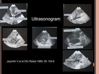 Ultrasonogram
Jayanthi V et al Clin Radiol 1988; 39: 154-8
 