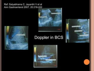 Doppler in BCS
Ref: Satyabhama C, Jayanthi V et al
Ann Gastroenterol 2007, 20:218-222
 