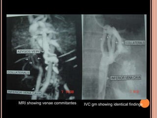MRI showing venae commitantes IVC gm showing identical findings
 