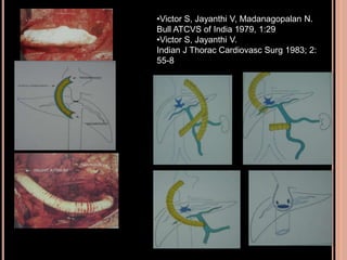 •Victor S, Jayanthi V, Madanagopalan N.
Bull ATCVS of India 1979, 1:29
•Victor S, Jayanthi V.
Indian J Thorac Cardiovasc Surg 1983; 2:
55-8
 