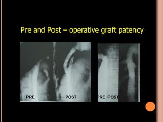 Pre and Post – operative graft patency
PRE POST PRE POST
 