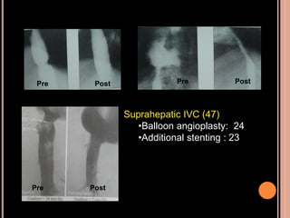 Suprahepatic IVC (47)
•Balloon angioplasty: 24
•Additional stenting : 23
Pre Post Pre Post
Pre Post
 