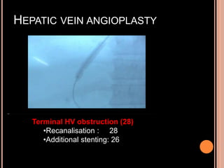 HEPATIC VEIN ANGIOPLASTY
Terminal HV obstruction (28)
•Recanalisation : 28
•Additional stenting: 26
 