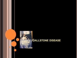 GALLSTONE DISEASE
 