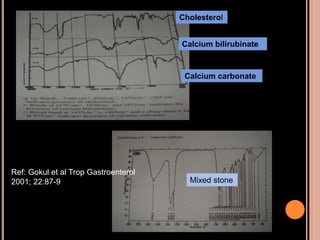 Cholesterol
Calcium bilirubinate
Calcium carbonate
Mixed stone
Ref: Gokul et al Trop Gastroenterol
2001; 22:87-9
 