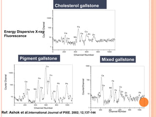 0 200 400 600 800 1000
1
10
100
1000
K
ZnZn
Cu
Fe
Fe
Mn
Ca
Ca
Counts/Channel
Channel Number
0 200 400 600 800 1000
10
100
1000
PbPb
Zn
Zn
Cu
Cu
Fe
Fe
MnCa
Ca
K
Counts/Channel
Channel Number
Cholesterol gallstone
0 200 400 600 800 1000
1
10
100
1000
PbZn
Zn
Cu
Fe
Fe
Mn
Ca
Ca
K
Counts/Channel
Channel Number
Mixed gallstonePigment gallstone
EDXRF
spectra
Energy Dispersive X-ray
Fluorescence
Ref: Ashok et al.International Journal of PIXE. 2002; 12,137-144
 