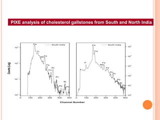 0 100 200 300 400 500
10
0
10
1
10
2
10
3
0 100 200 300 400 500
10
0
10
1
10
2
10
3
10
4
10
5
South India
Ti
Mn
Pb
Pb
Br
Zn
Zn
Cu
Fe
Fe
Ca
Counts(Log)
P
North India
Pb
Br
Pb
Zn
Zn
Fe
Mn
Fe
Ca
Ca
Channel Number
PIXE analysis of cholesterol gallstones from South and North India
 