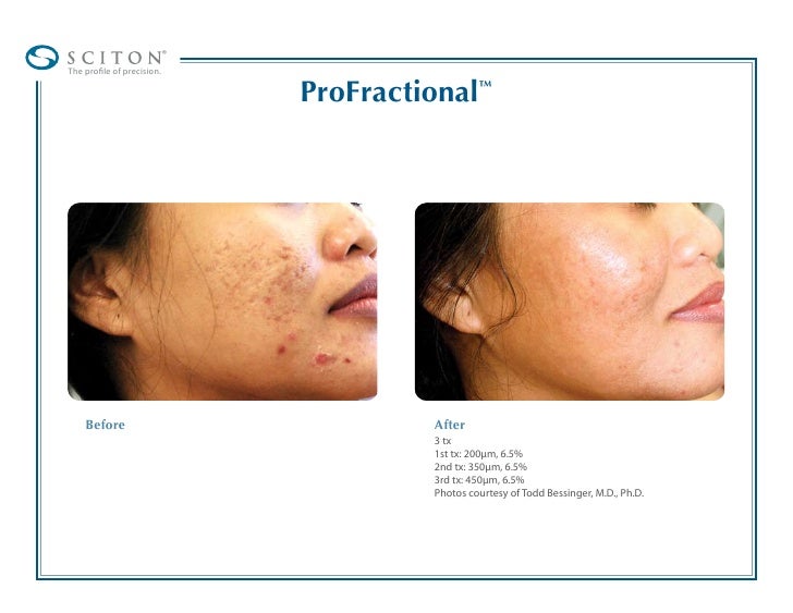 Acne Scar Removal Breakthrough! ProFractional Laser v1