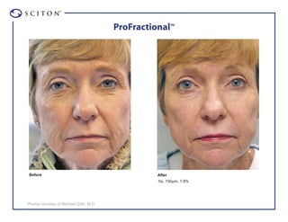 ®



                                        ProFractional™




 Before                                           After
                                                  1tx, 150µm, 1.9%




Photos courtesy of Michael Gold, M.D.
 