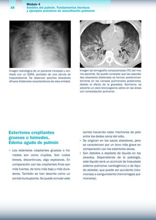 Módulo 4
Sonidos del pulmón. Fundamentos técnicos
y ejemplos prácticos de auscultación pulmonar
16
Imagen radiológica de un paciente intubado y ven-
tilado con un SDRA, portador de una cánula de
traqueostomía. Se observan parches alveolares
difusos bilaterales característicos de esta entidad.
Imagen de tomografía computarizada (TC) del mis-
mo paciente. Se puede constatar que las opacida-
des alveolares bilaterales se forman predominan-
temente en los campos pulmonares posteriores,
debido al efecto de la gravedad. Asimismo, se
advierte un claro broncograma aéreo en las áreas
con consolidación pulmonar.
Estertores crepitantes
gruesos o húmedos.
Edema agudo de pulmón
•	 Los estertores crepitantes gruesos o hú-
medos son como crujidos. Son ruidos
breves, discontinuos, algo explosivos. En
comparación con los crepitantes finos son
más fuertes, de tono más bajo y más dura-
deros. También se han descrito como un
sonido burbujeante. Se puede simular este
sonido haciendo rodar mechones de pelo
entre los dedos cerca del oído.
•	 Se originan en los sacos alveolares, pero
se caracterizan por un tono más grave en
comparación con los estertores secos.
•	 Son debidos a depósito de líquido en los
alveolos. Dependiendo de la patología,
este líquido será un acúmulo de trasudado
(edema pulmonar cardiogénico) o de líqui-
do alveolar, que puede ser purulento (neu-
monías) o sanguinolento (hemorragias pul-
monares).
 