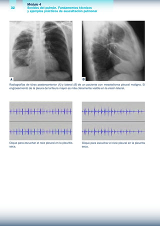 Módulo 4
Sonidos del pulmón. Fundamentos técnicos
y ejemplos prácticos de auscultación pulmonar
32
Clique para escuchar el roce pleural en la pleuritis
seca.
Clique para escuchar el roce pleural en la pleuritis
seca.
Radiografías de tórax posteroanterior (A) y lateral (B) de un paciente con mesotelioma pleural maligno. El
engrosamiento de la pleura de la fisura mayor es más claramente visible en la visión lateral.
A B
 