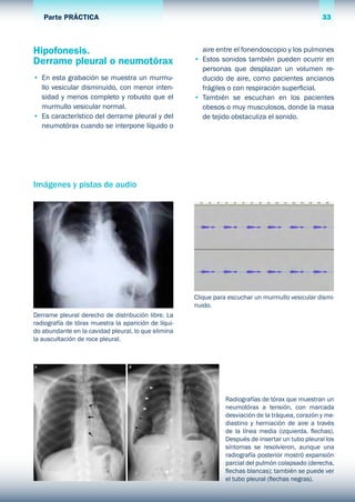 33Parte PRÁCTICA
Hipofonesis.
Derrame pleural o neumotórax
•	 En esta grabación se muestra un murmu-
llo vesicular disminuido, con menor inten-
sidad y menos completo y robusto que el
murmullo vesicular normal.
•	 Es característico del derrame pleural y del
neumotórax cuando se interpone líquido o
aire entre el fonendoscopio y los pulmones
•	 Estos sonidos también pueden ocurrir en
personas que desplazan un volumen re-
ducido de aire, como pacientes ancianos
frágiles o con respiración superficial.
•	 También se escuchan en los pacientes
obesos o muy musculosos, donde la masa
de tejido obstaculiza el sonido.
Radiografías de tórax que muestran un
neumotórax a tensión, con marcada
desviación de la tráquea, corazón y me-
diastino y herniación de aire a través
de la línea media (izquierda, flechas).
Después de insertar un tubo pleural los
síntomas se resolvieron, aunque una
radiografía posterior mostró expansión
parcial del pulmón colapsado (derecha,
flechas blancas); también se puede ver
el tubo pleural (flechas negras).
Derrame pleural derecho de distribución libre. La
radiografía de tórax muestra la aparición de líqui-
do abundante en la cavidad pleural, lo que elimina
la auscultación de roce pleural.
Imágenes y pistas de audio
Clique para escuchar un murmullo vesicular dismi-
nuido.
 