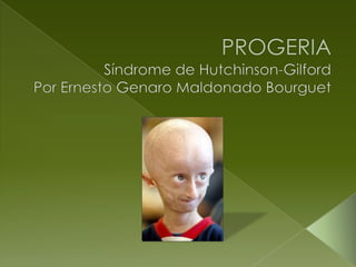 PROGERIA Síndrome de Hutchinson-Gilford Por Ernesto Genaro Maldonado Bourguet 
