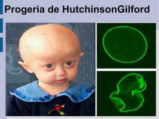Progeria de HutchinsonGilford

 