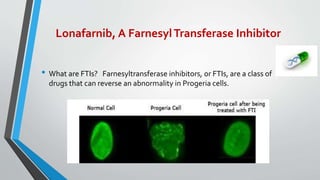 Lonafarnib, A FarnesylTransferase Inhibitor
• What are FTIs? Farnesyltransferase inhibitors, or FTIs, are a class of
drugs that can reverse an abnormality in Progeria cells.
 