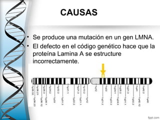 CAUSAS
• Se produce una mutación en un gen LMNA.
• El defecto en el código genético hace que la
proteína Lamina A se estructure
incorrectamente.
 