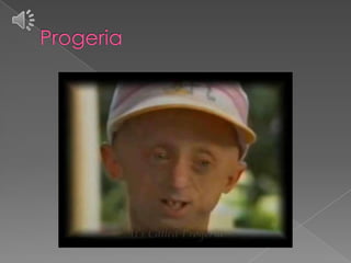 Progeria , by Lucia