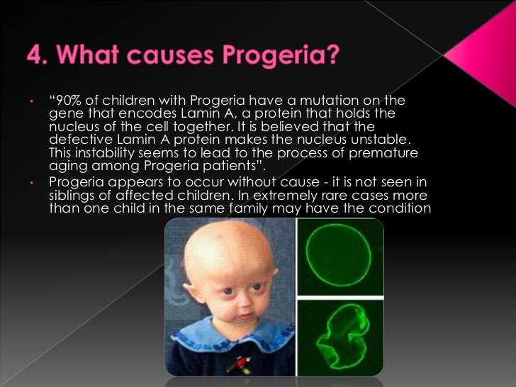 Progeria By Lucia