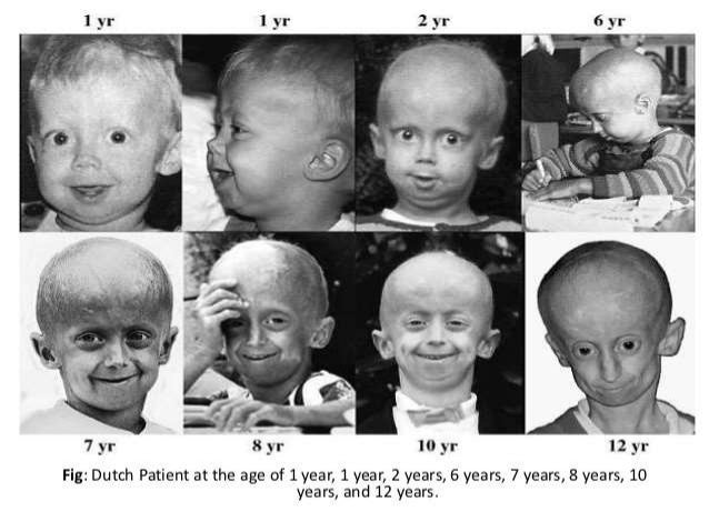 Hutchinson Gilford Progeria Syndrome Hgps